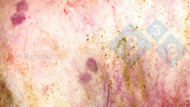 Figura 1. Lesão cutânea em forma de diamante quase patognomônica.