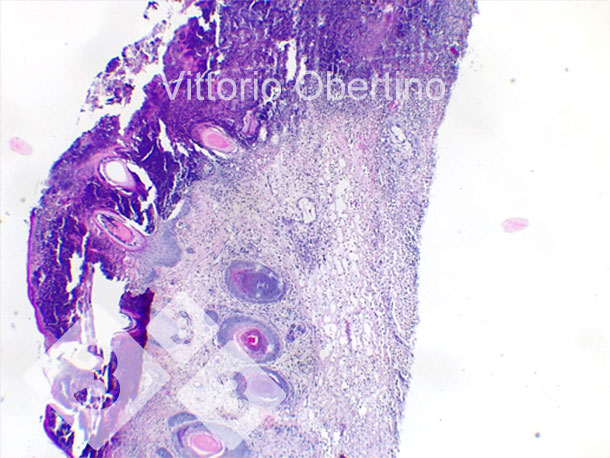 Figura 9. Pele. Eros&atilde;o epitelial focal em que a camada superficial &eacute; substitu&iacute;da por abundante material amorfo a granular eosinof&iacute;lico com detritos carior&eacute;ticos (necrose) e abundantes granul&oacute;citos degenerados e neutrof&iacute;licos vi&aacute;veis. Multifocalmente, o epit&eacute;lio parece moderadamente a acentuadamente hiperpl&aacute;sico com hiperceratose ortoquerat&oacute;tica moderada a grave. Tamb&eacute;m h&aacute; presen&ccedil;a multifocal de crostas. A derme parece difusa e moderadamente fibr&oacute;tica.
