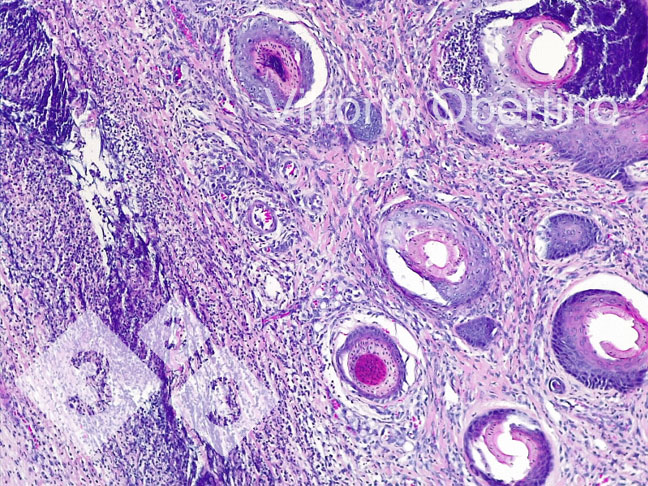 Figura 8. Umbigo. &Aacute;rea d&eacute;rmica localmente extensa composta por fibroplasia com fibroblastos ativados e numerosos pequenos vasos imaturos (tecido de granula&ccedil;&atilde;o neoformado), infiltrado inflamat&oacute;rio multifocal com predom&iacute;nio de c&eacute;lulas linfoplasmacelulares; em algumas estruturas vasculares existe um infiltrado inflamat&oacute;rio granuloc&iacute;tico que circunda a parede do vaso e infiltra-se focalmente (vasculite leucocit&aacute;ria).
