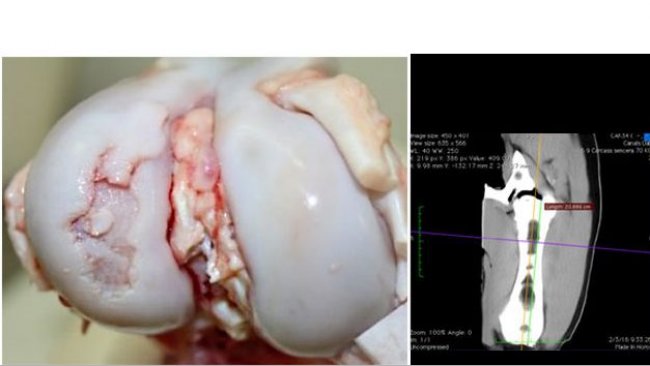 Vis&atilde;o macrosc&oacute;pica da articula&ccedil;&atilde;o do joelho com les&atilde;o de osteocondrose grave no c&ocirc;ndilo lateral do f&ecirc;mur.
