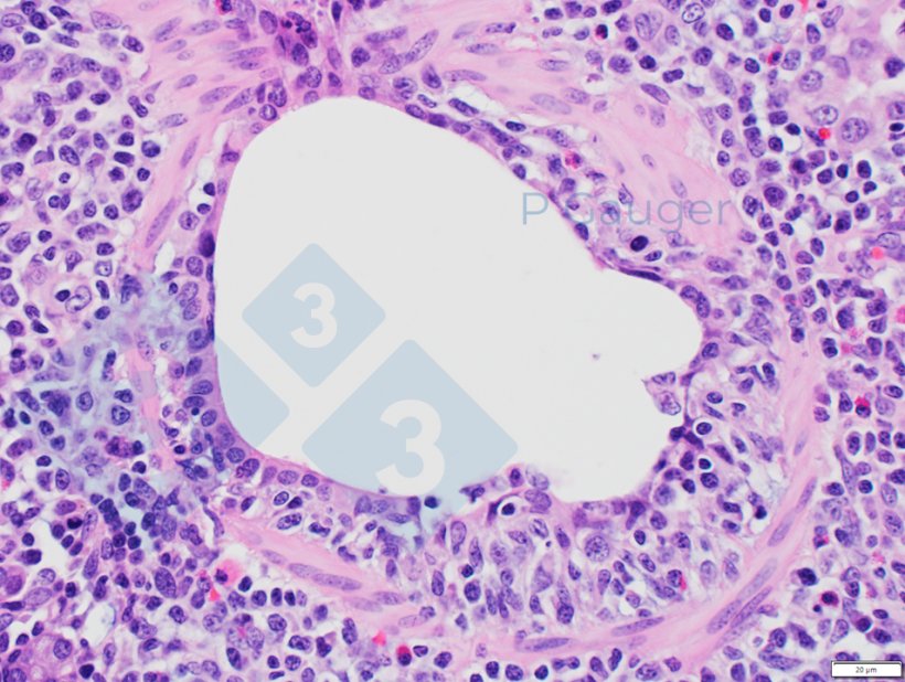 Figura 4: Histopatologia pulmonar mostrando adelga&ccedil;amento do epit&eacute;lio bronquiolar, que &eacute; um exemplo de necrose. (Fonte da foto: Phil Gauger ISUVDL).
