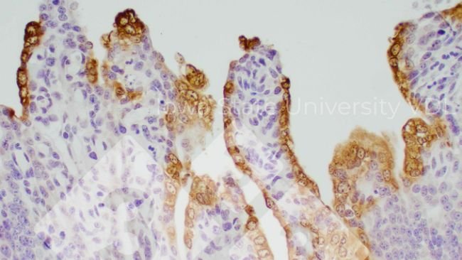 Figura 1. Colora&ccedil;&atilde;o IHC de PED&nbsp;no intestino delgado infectado. Fonte: VDL da Universidade Estadual de Iowa.
