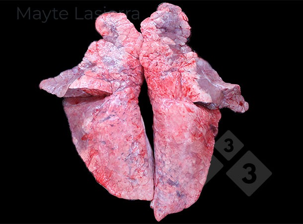 Proceso bronconeumónico