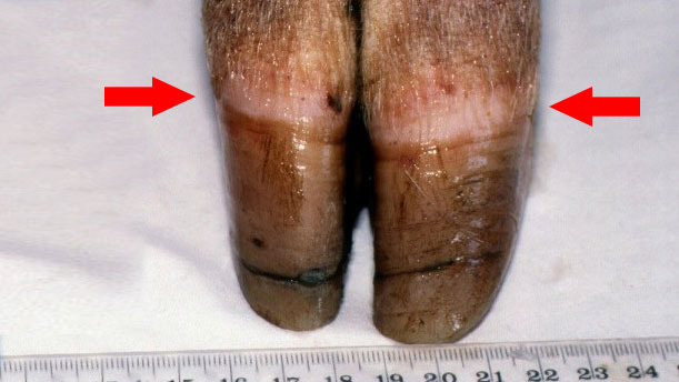 Borda coron&aacute;ria