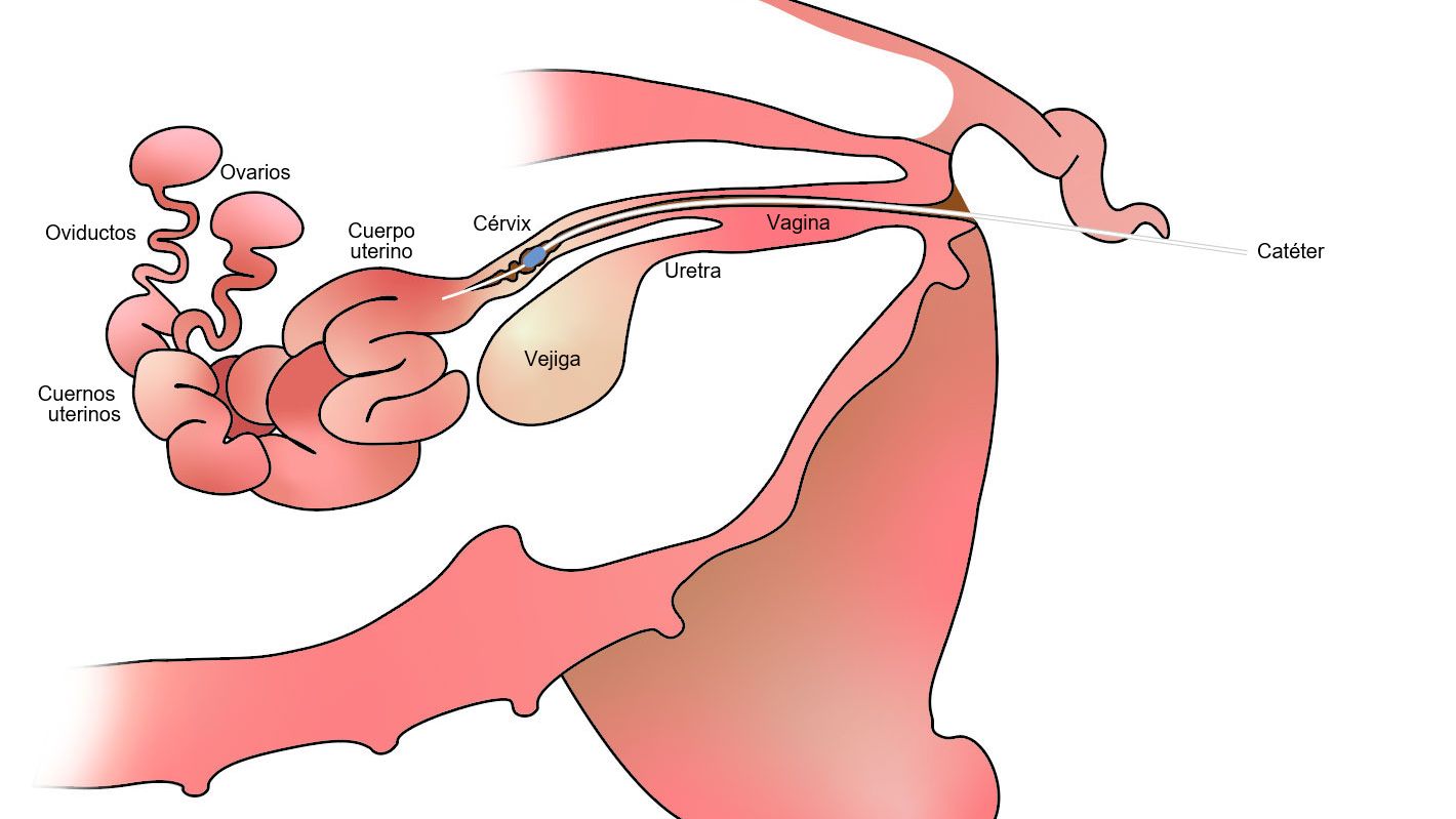 Figura 1. Com a insemina&ccedil;&atilde;o p&oacute;s-cervical, o s&ecirc;men &eacute; depositado no corpo uterino, ap&oacute;s o colo do &uacute;tero.
